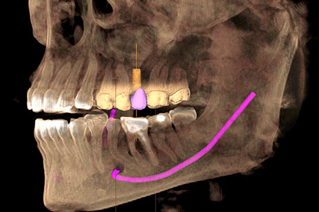 ¿Para qué mi dentista me manda a tomar una tomografía dental?