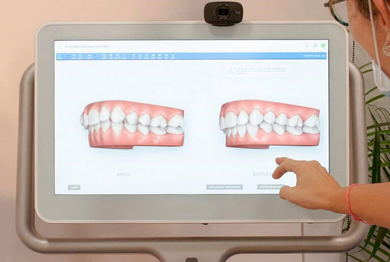 Escaneado intraoral digital