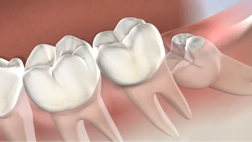 Extracciones de dientes en ortodoncia