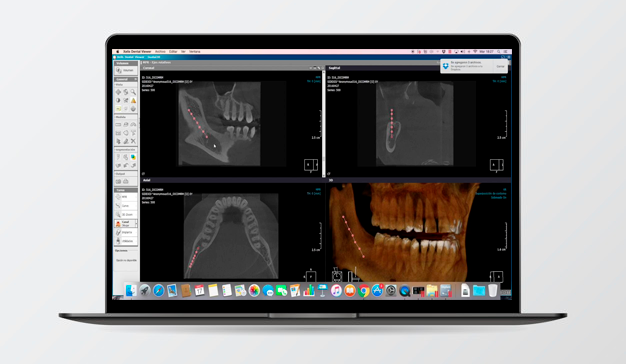 Tomografía computarizada Cone Beam en endodoncia