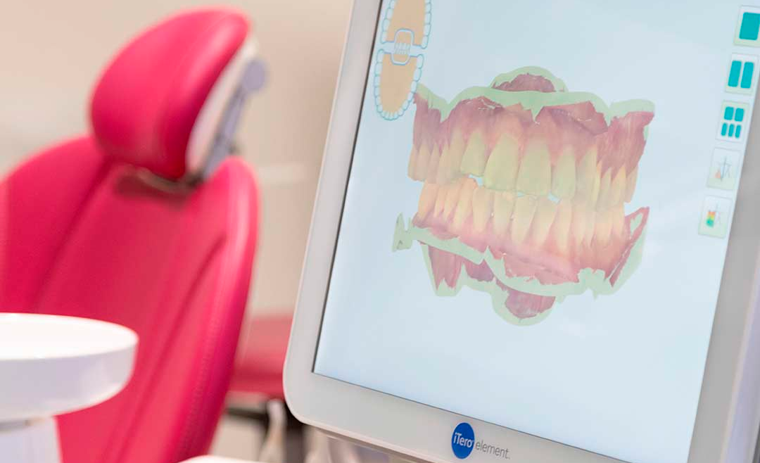 Impulsa tu Práctica Odontológica con el Escáner iTero de DICORSA: Diagnóstico Preciso a tu Alcance