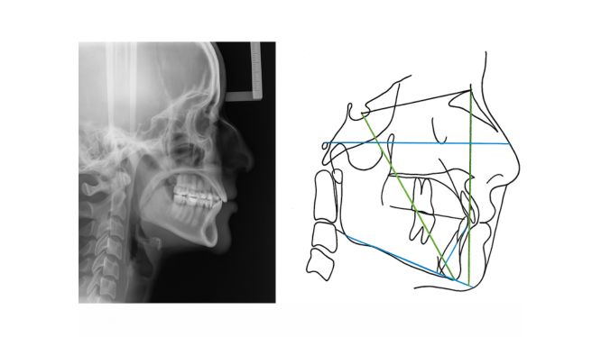 Comparación entre una radiografía cefalométrica lateral y su trazado esquemático con líneas de análisis ortodóncico en azul y verde, utilizada para evaluar proporciones craneofaciales en diagnóstico dental.