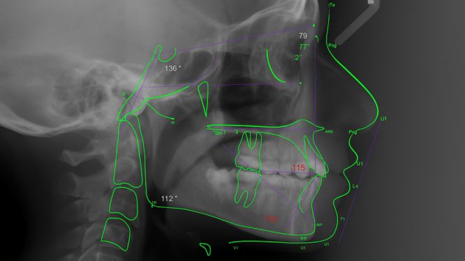 Radiografía cefalométrica lateral con trazado digital y mediciones angulares en verde y rojo, utilizada en el diagnóstico ortodóntico para evaluar relaciones óseas y dentales en estudios radiológicos de alta precisión.