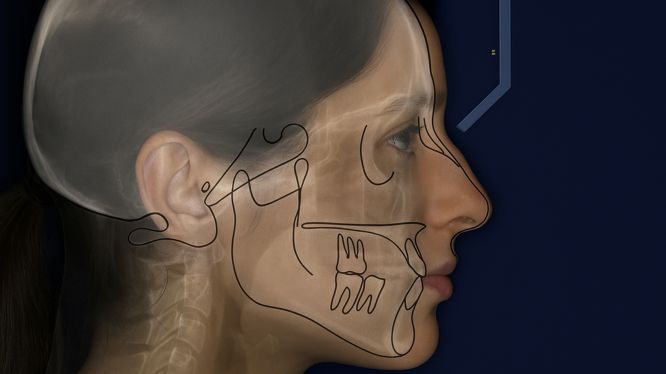 Radiografía cefalométrica lateral con trazado anatómico sobre el perfil de una mujer, utilizada en análisis ortodóntico para diagnóstico preciso en estudios radiológicos dentales.