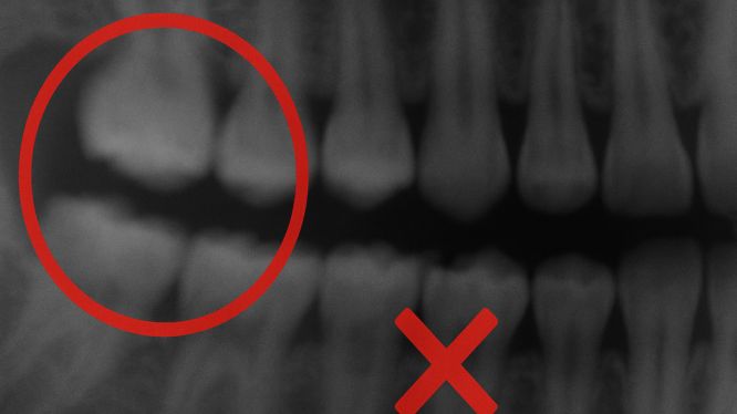 Radiografía intraoral borrosa con dientes poco definidos, señalada con un círculo rojo y una equis que indica un error en la toma de la imagen.