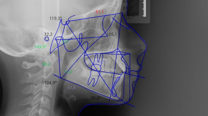 Cefalométrica lateral
