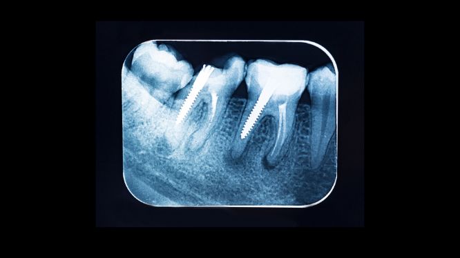 Radiografía periapical