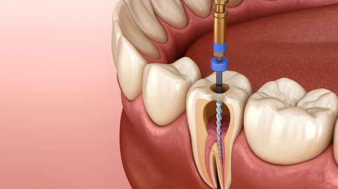 tratamiento de endodoncia