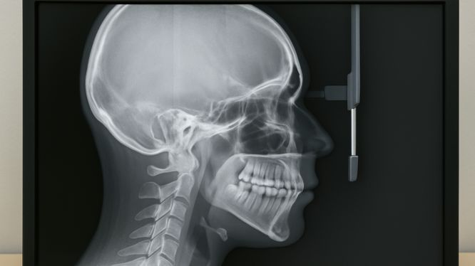 Radiografía Cefalométrica Lateral