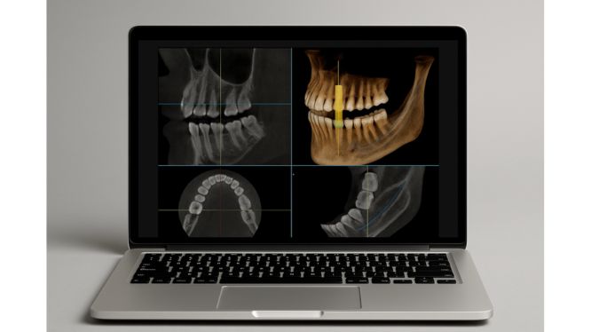 Tomografía dental y planificación quirúrgica