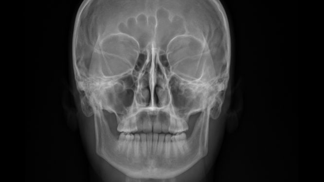 Radiografía Caldwell: la proyección esencial para evaluar senos paranasales y estructuras faciales