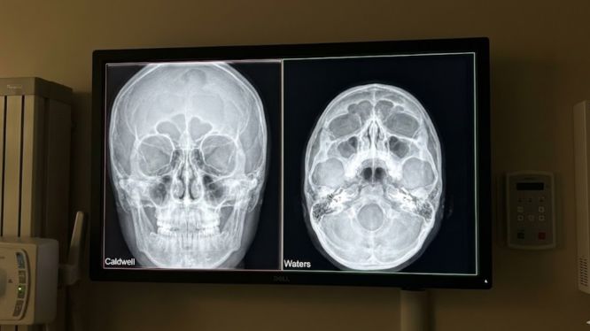 Proyección Caldwell vs proyección Waters: diferencias, usos y cuándo elegir cada una