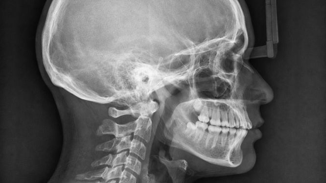 Radiografía lateral de cráneo