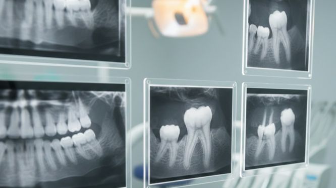 Radiografías intraorales: cuando se necesita ver el detalle