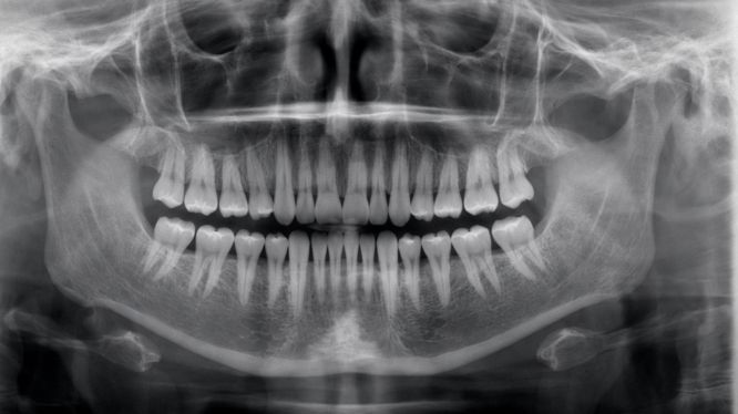 Radiografía panorámica: errores comunes que pueden afectar tu diagnóstico (y cómo evitarlos)