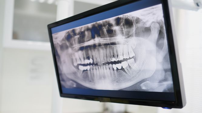 ¿Cada cuánto se deben hacer radiografías dentales?