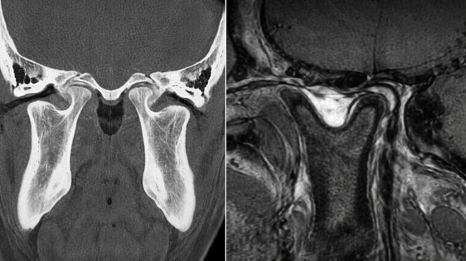 RX ATM: ¿Qué estudio es mejor para evaluar la articulación temporomandibular?