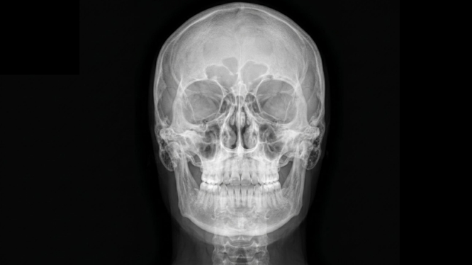 Radiografía anteroposterior en odontología: cuándo se solicita y qué información aporta al diagnóstico