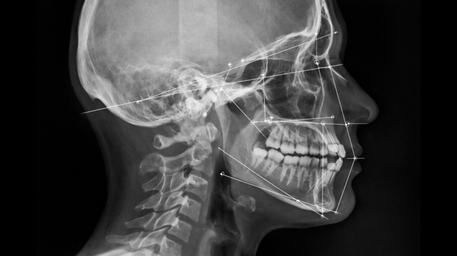 Cefalometría dental: cómo ayuda a diagnosticar problemas de crecimiento y ortodoncia