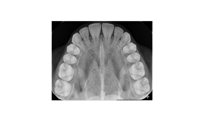 Radiografía periapical y oclusal: cuándo se utilizan y por qué son clave en el diagnóstico dental