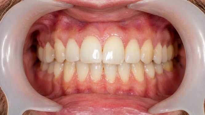 Fotografía intraoral en odontología: cómo mejora el diagnóstico y seguimiento del paciente