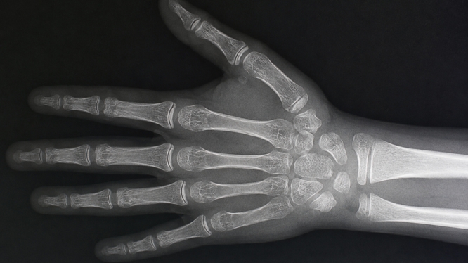 Radiografía Carpal: ¿Qué es, para qué sirve y por qué es TAN importante en ortodoncia y crecimiento infantil?
