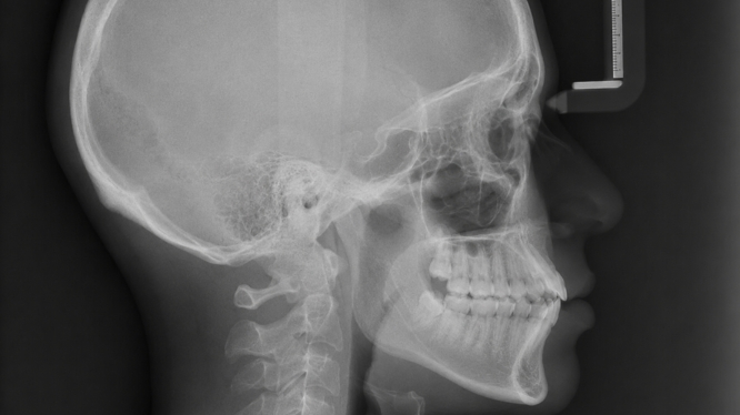 Radiografía lateral de cráneo: por qué es clave en ortodoncia y crecimiento facial